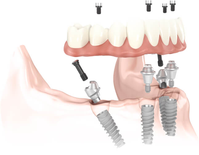 all-on-4-dental-implant