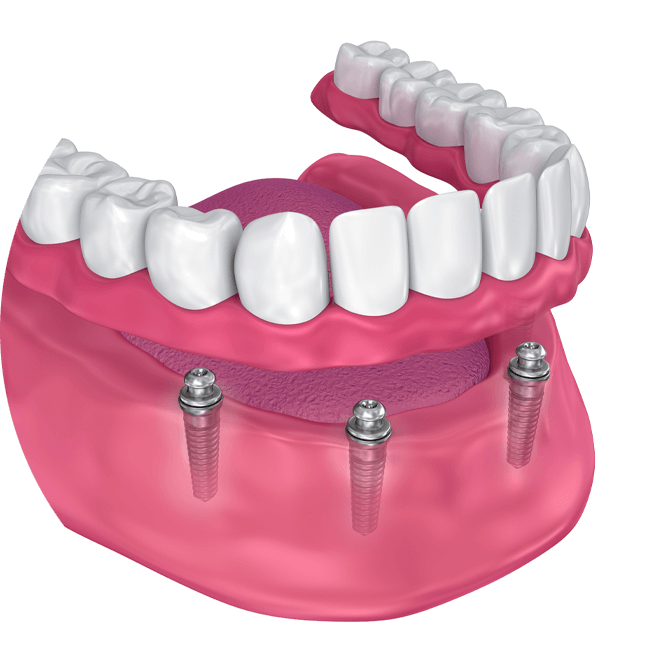 implant supported dentures graphic