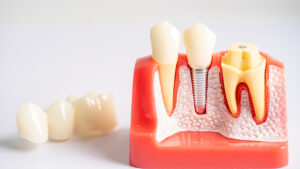 Dental Crown