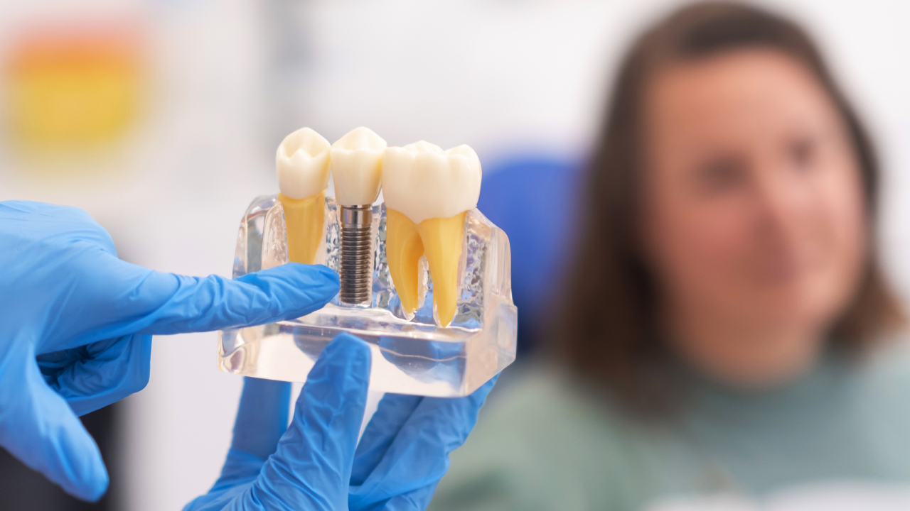 Dental Implants