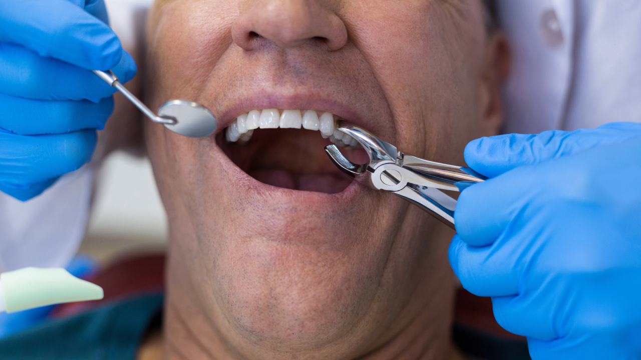 Tooth Extraction